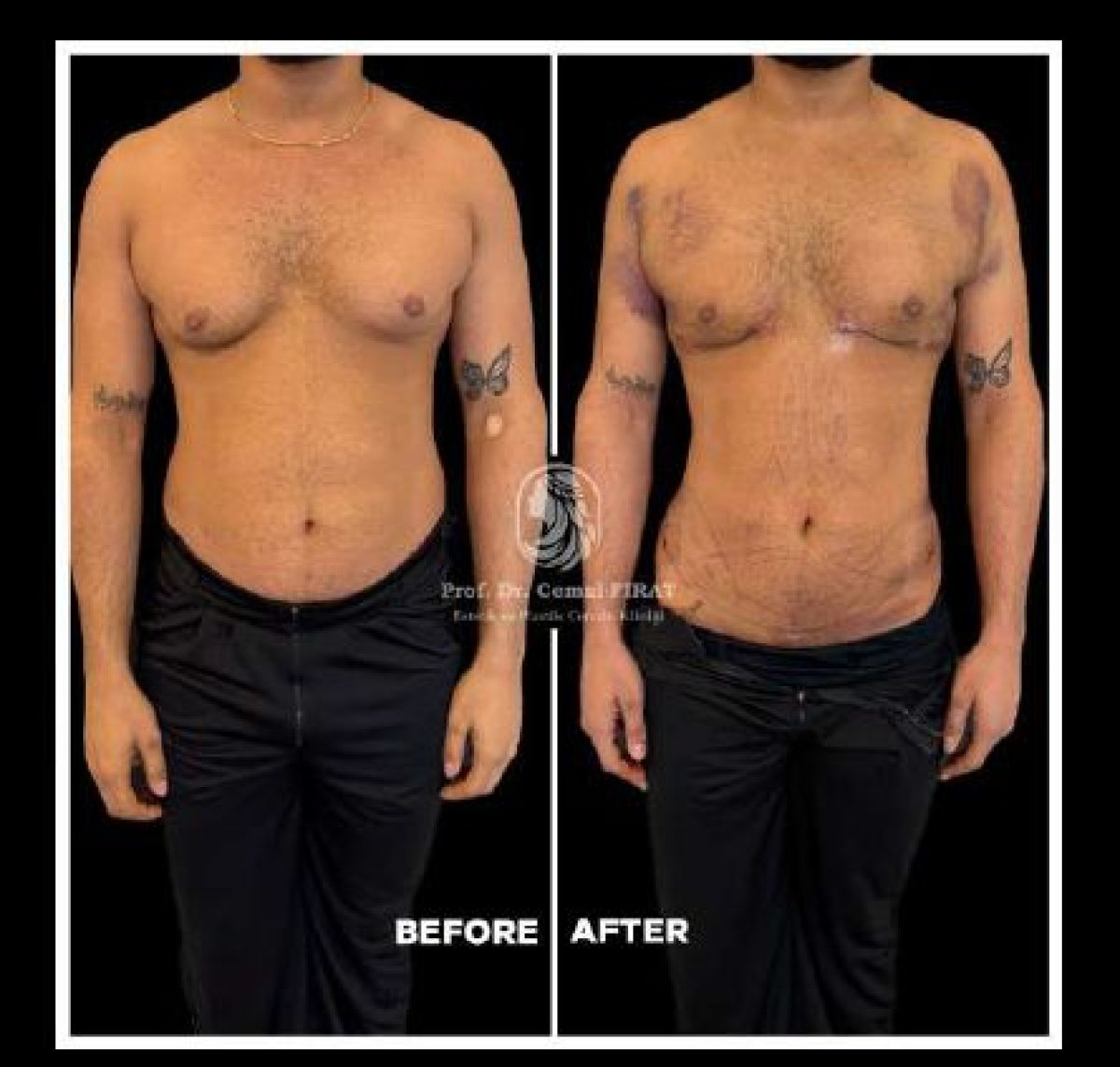 Before and after abdominal etching results at Medical Park Antalya Hospital Complex, six pack abs