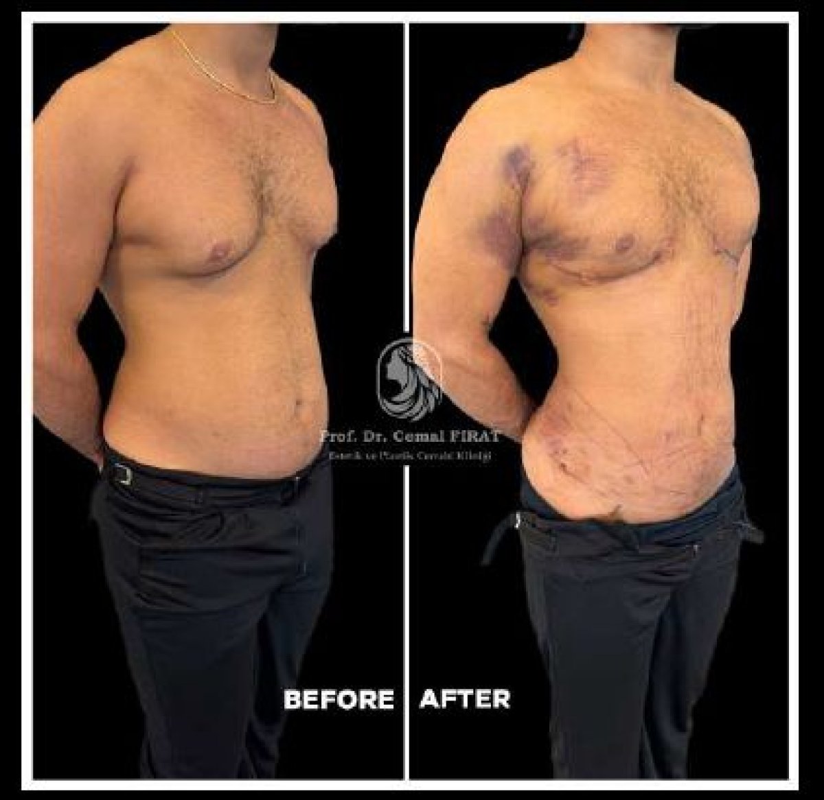 Before and after abdominal etching results at Medical Park Antalya Hospital Complex, six pack abs