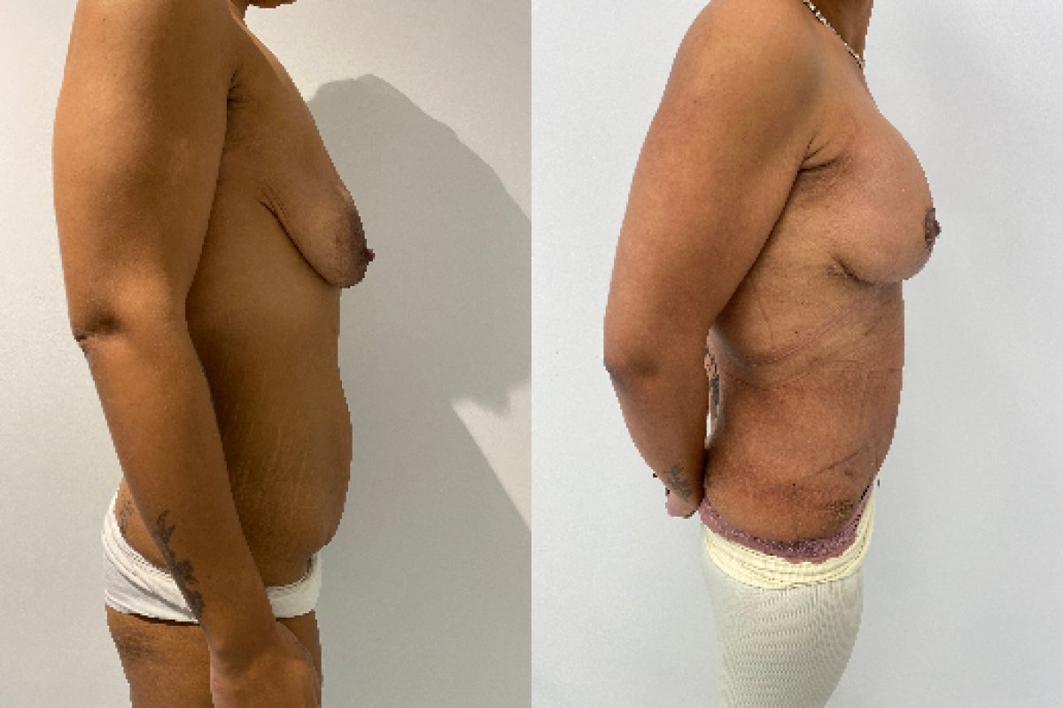Résultats avant/après mommy makeover – silhouette du ventre et des seins améliorée