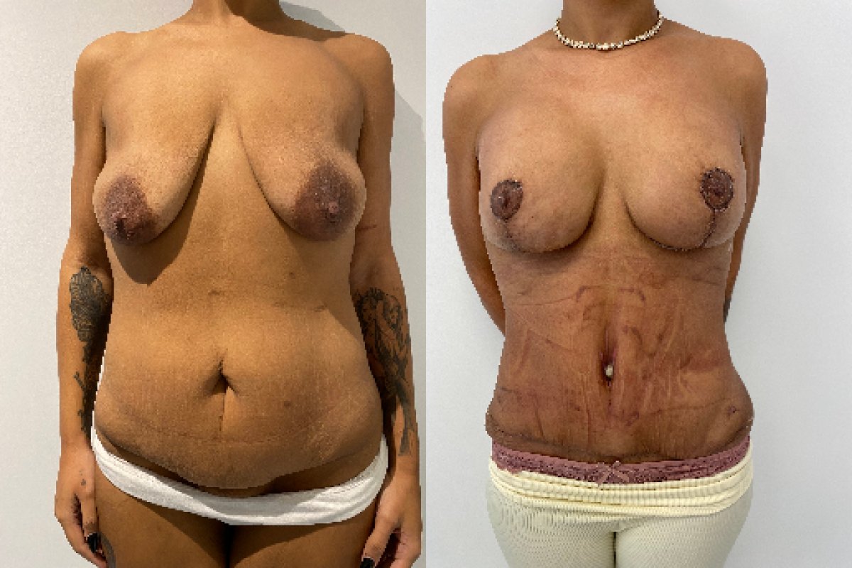 Résultats avant/après mommy makeover – lifting des seins et amélioration du ventre