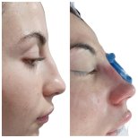 Before and after Rhinoplasty (nose job) photos by Dr. 