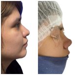 Before and after Rhinoplasty (nose job) photos by Dr. 