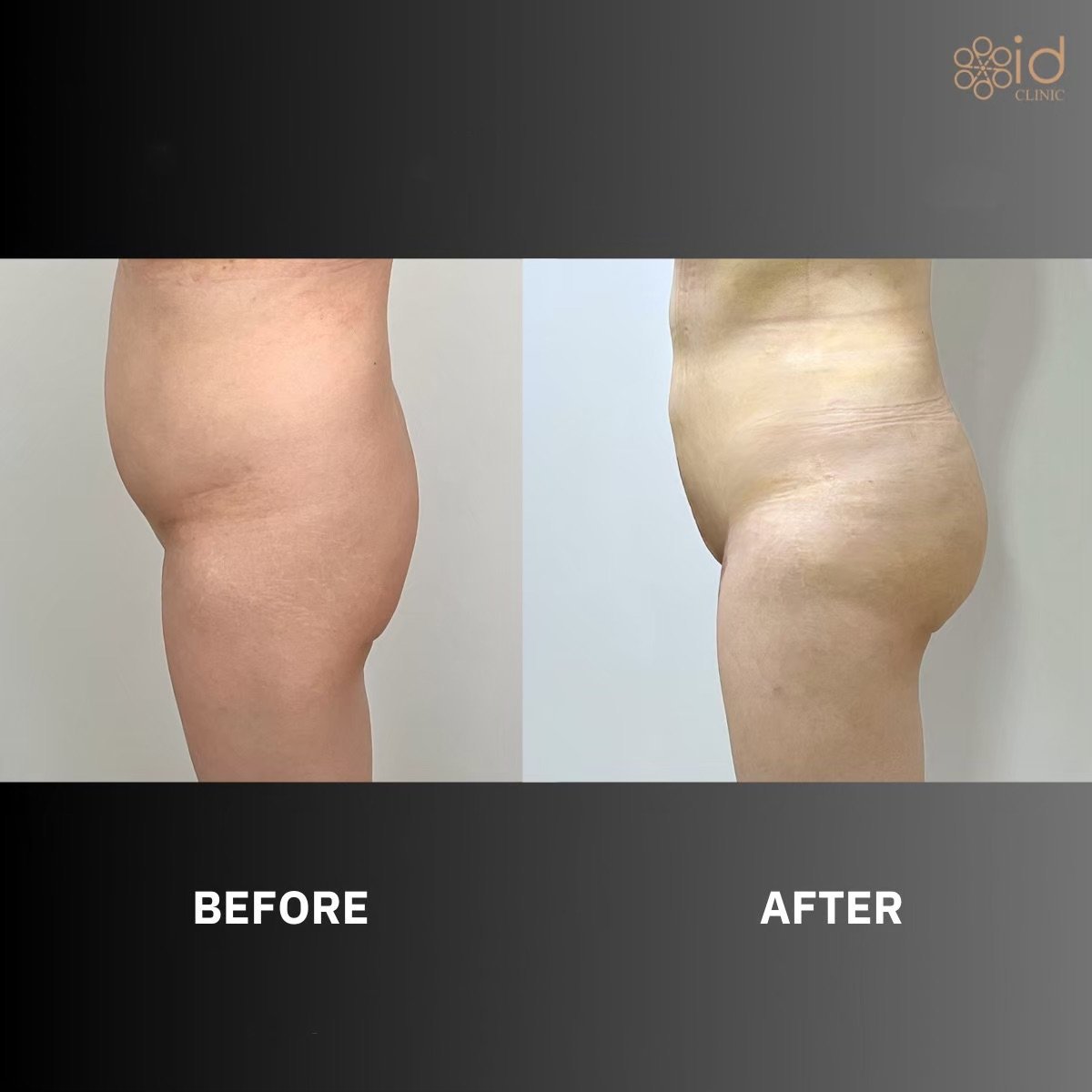 Before and after buttock lift results at ID Clinic Bangkok, improved contour and firmness
