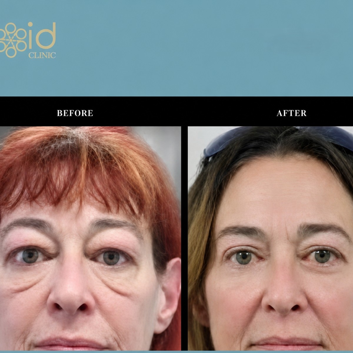 Before and after droopy eyelid surgery results at ID Clinic Bangkok, improved eye appearance