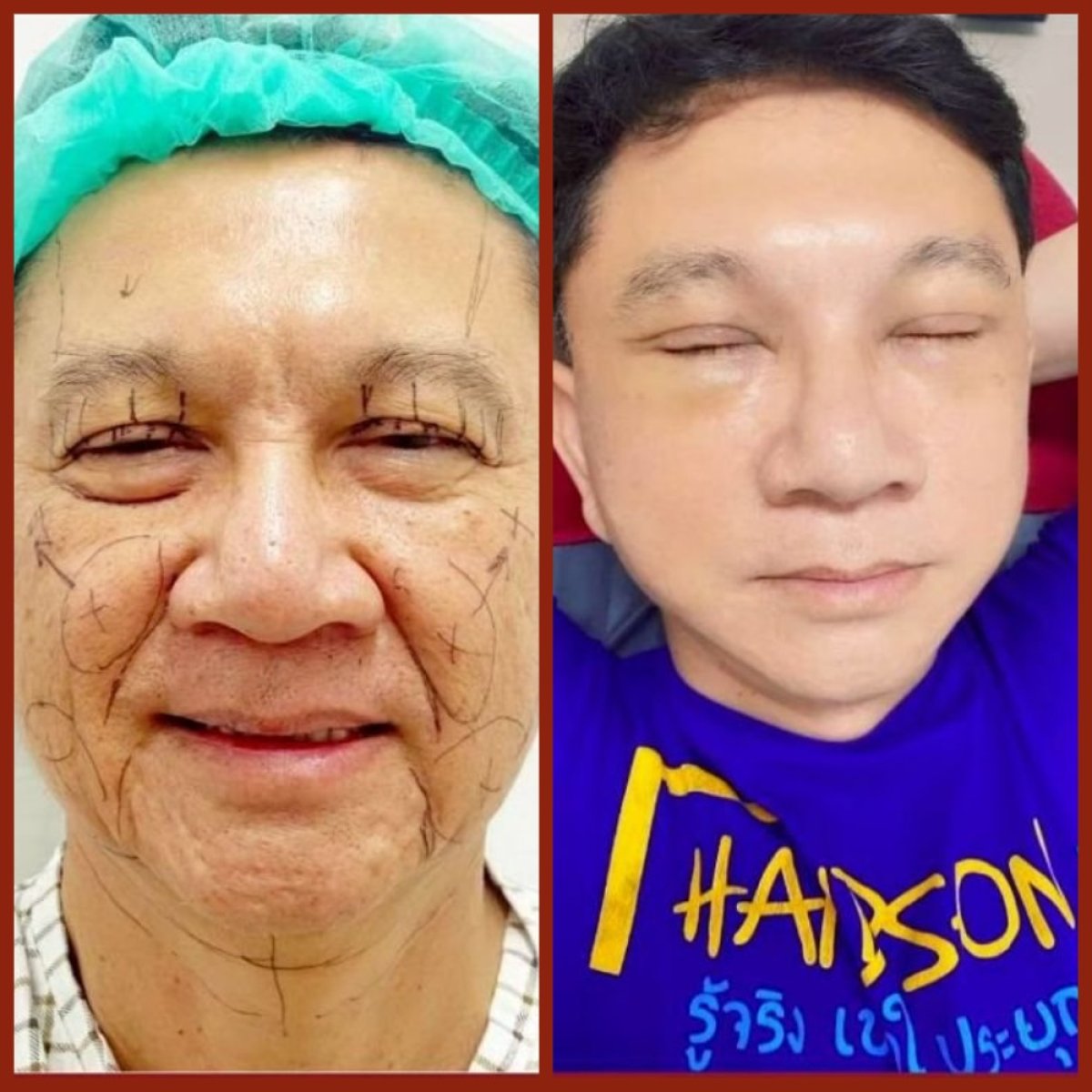 Resultados de lifting facial antes y después en DGB Clinic – rejuvenecimiento visible