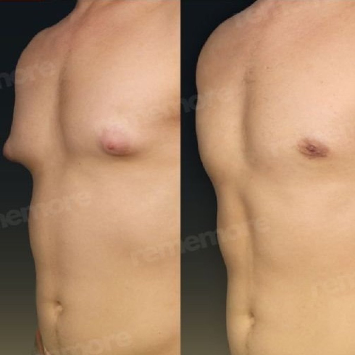 Résultats avant/après liposuccion Vaser du torse masculin à Memorial Göztepe Hospital