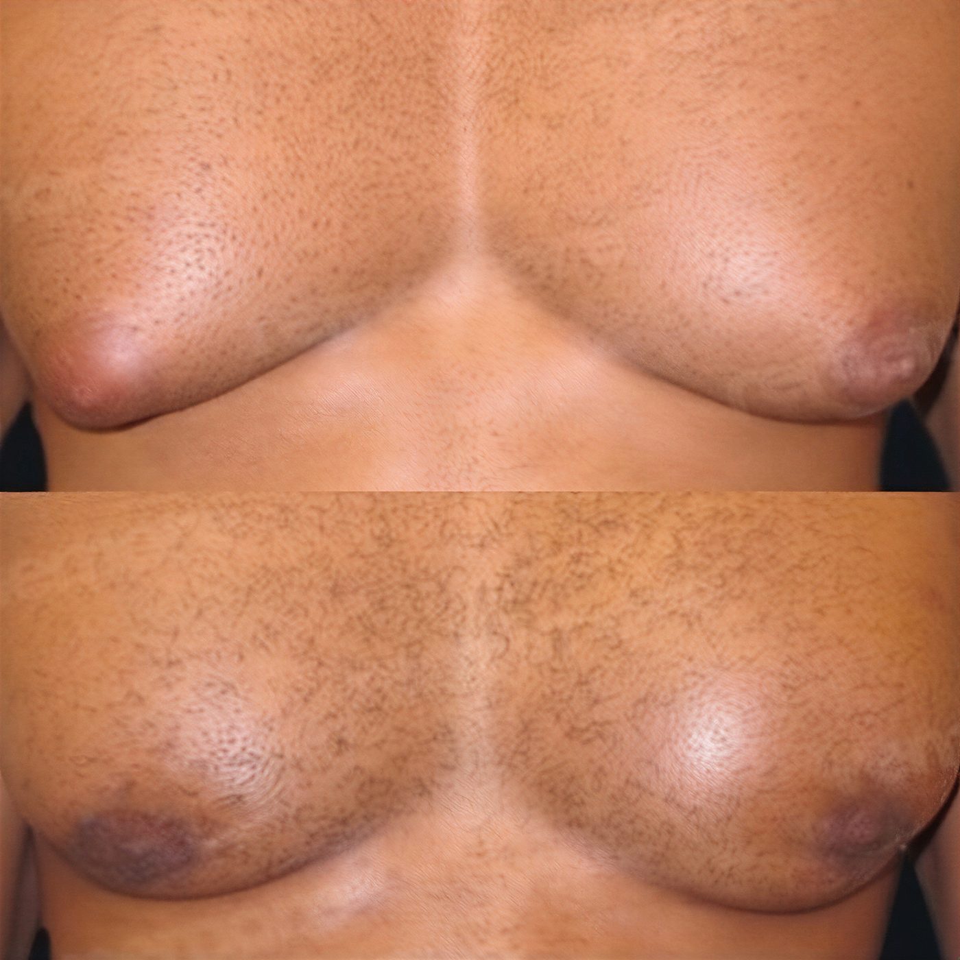 Resultados antes y después de liposucción Vaser en pecho en Memorial Göztepe Hospital