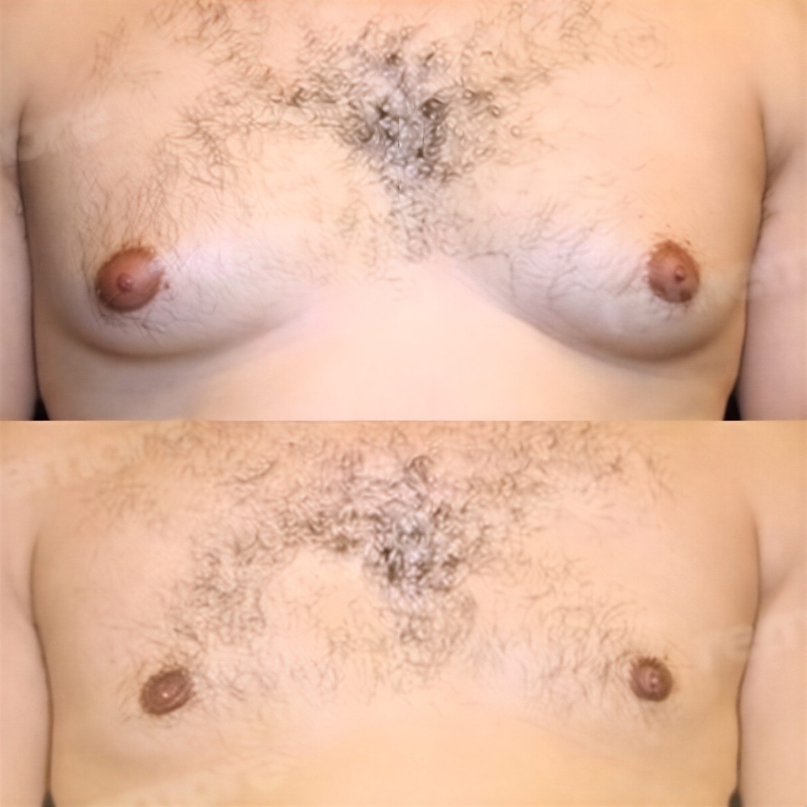Resultados antes y después de liposucción Vaser en pecho masculino en Memorial Göztepe Hospital