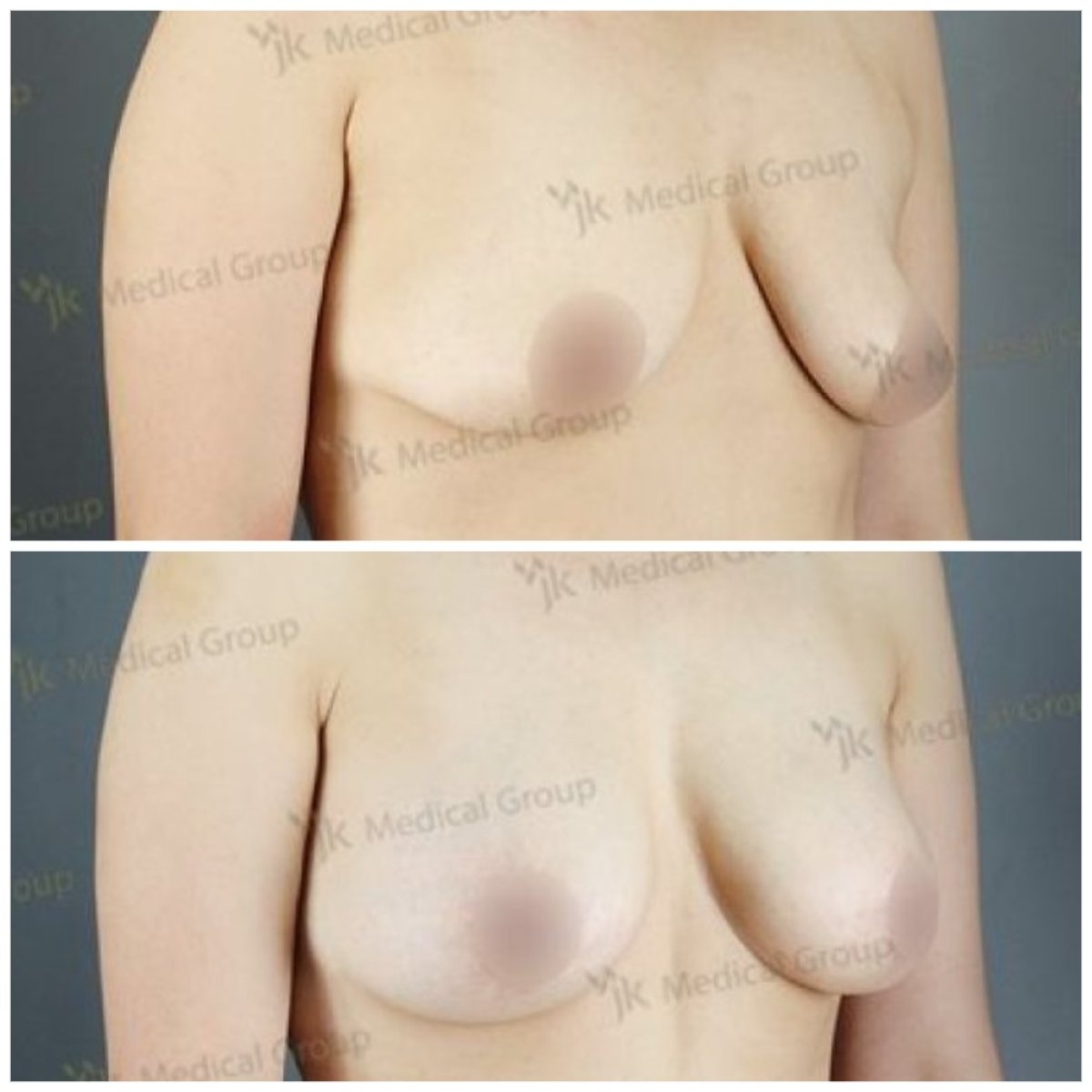 Before and after mommy makeover results at JK Plastic Surgery Center, breast lift and contour