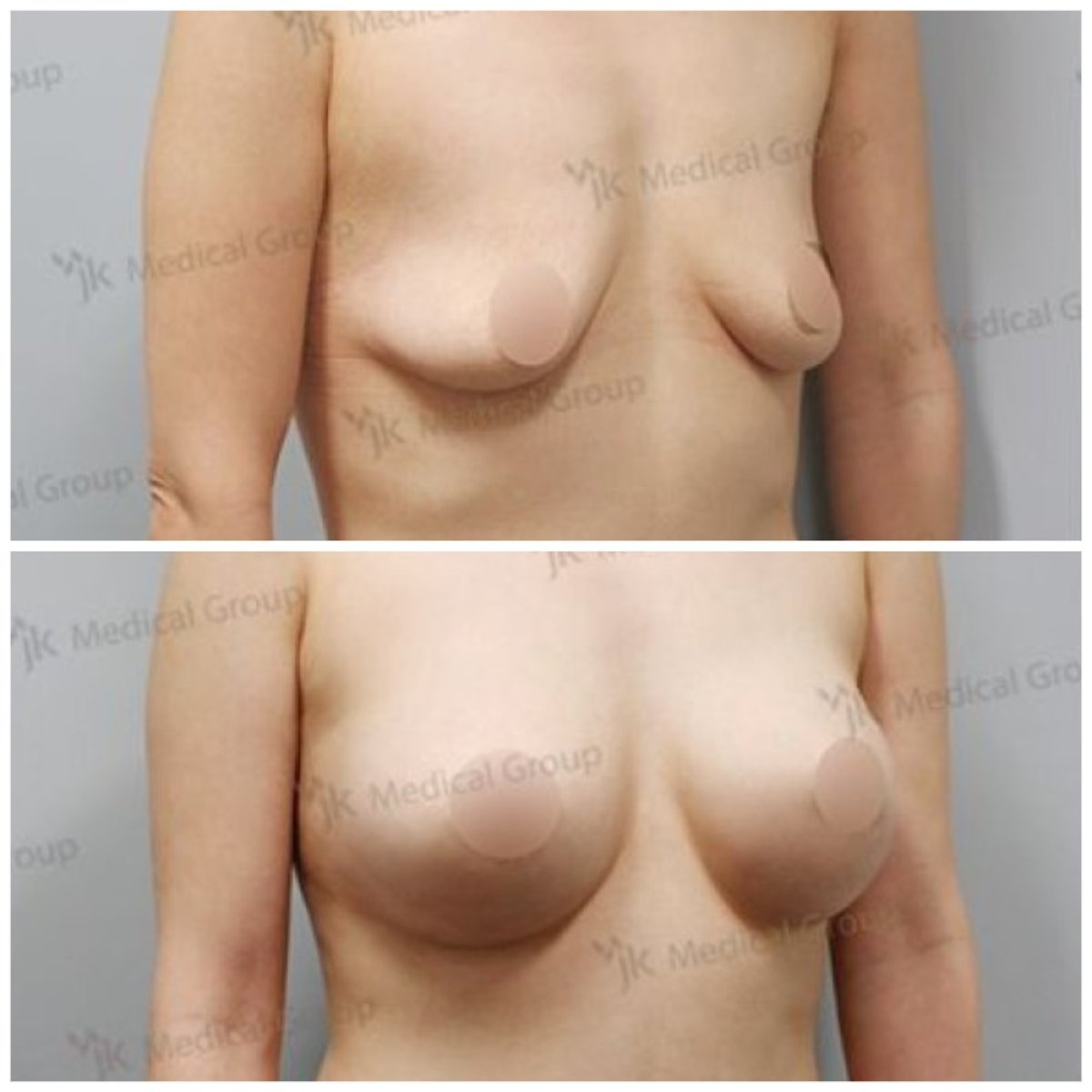 Before and after mommy makeover at JK Plastic Surgery Center, visible breast enhancement result
