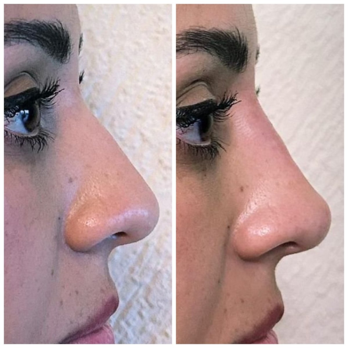 Resultados antes y después de rinoplastia con relleno, remodelación nasal no quirúrgica