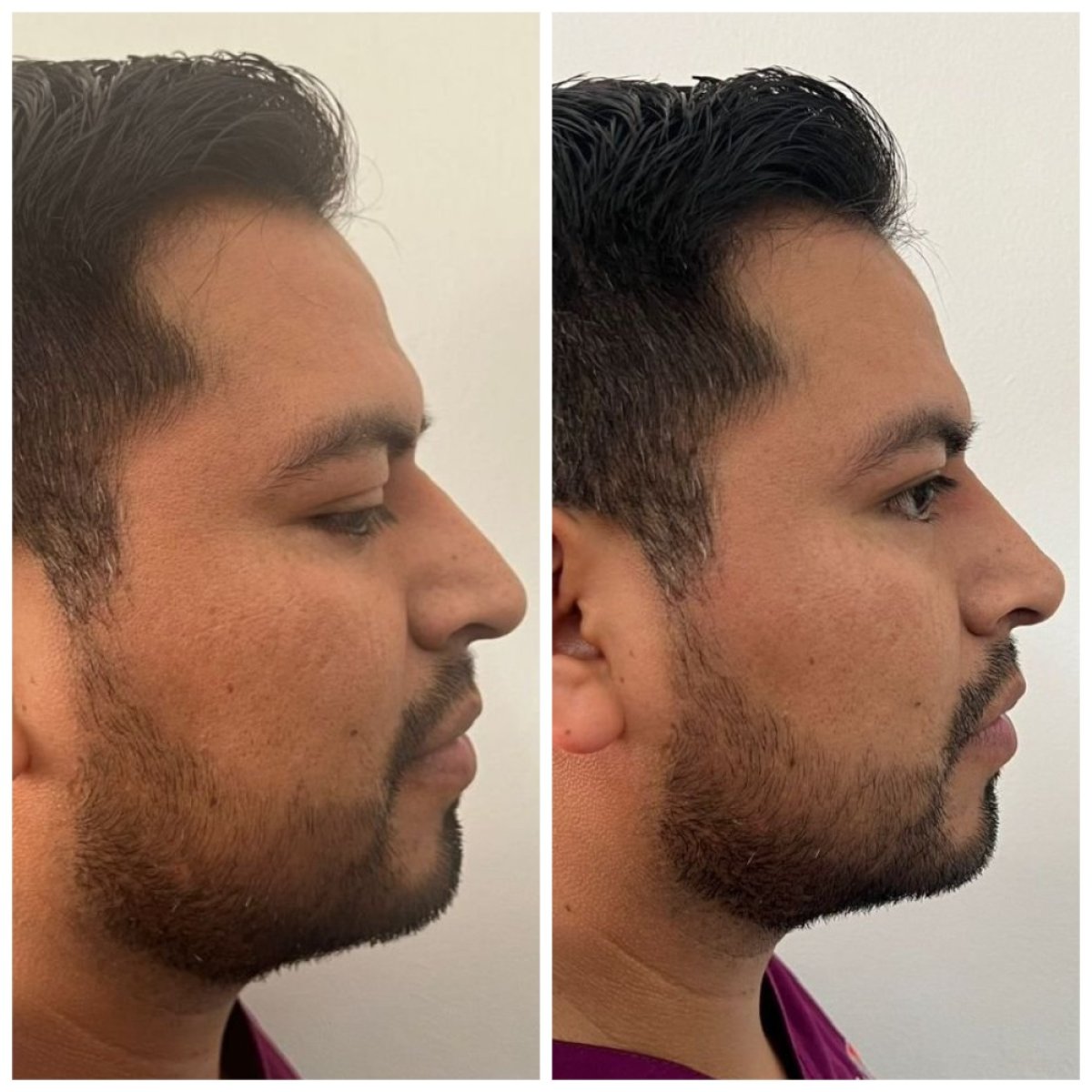 Vorher-nachher-Ergebnis Filler-Rhinoplastik, nicht-chirurgische Nasenkorrektur bei Männern