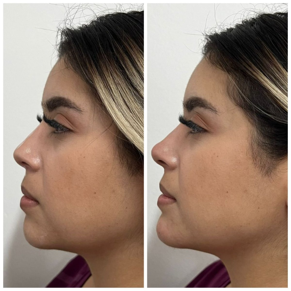 Before and after filler rhinoplasty results, non-surgical nose reshaping with natural look
