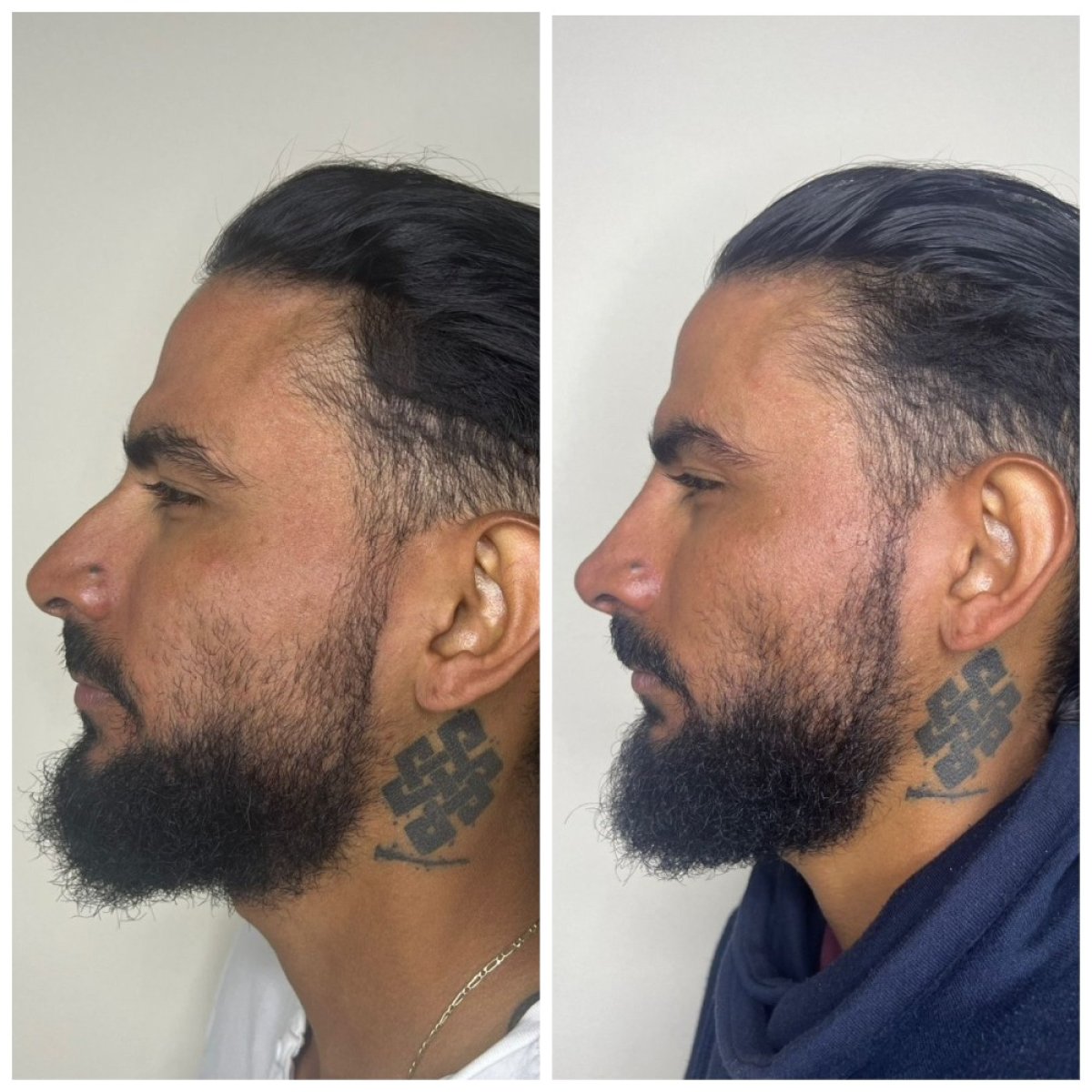 Resultados antes y después de rinoplastia con relleno, remodelación nasal sin cirugía en hombres