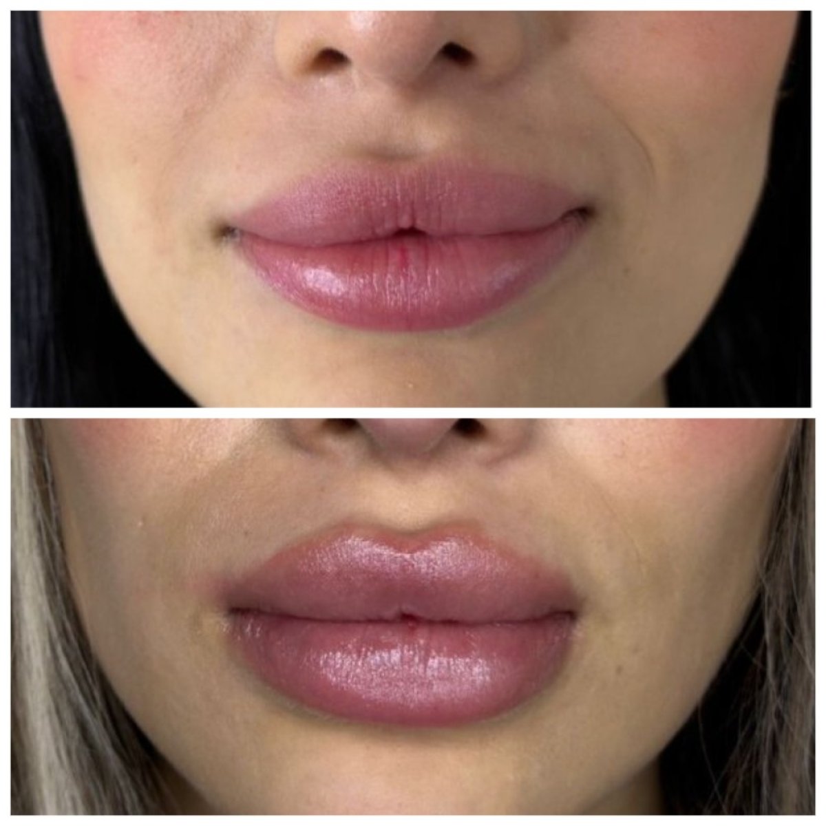 Resultados antes y después de relleno de labios: mayor volumen y mejor contorno labial