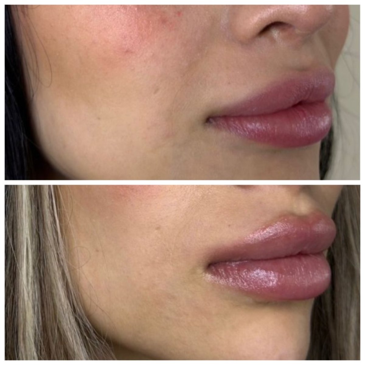 Resultado antes y después de rellenos – aumento de volumen y contorno de labios
