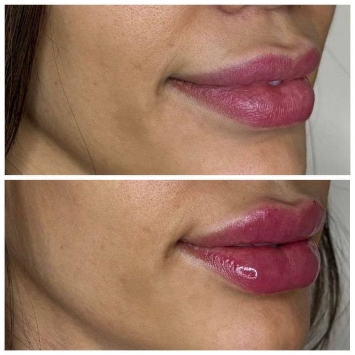 Résultats avant/après injection de fillers lèvres – volume et contour des lèvres améliorés