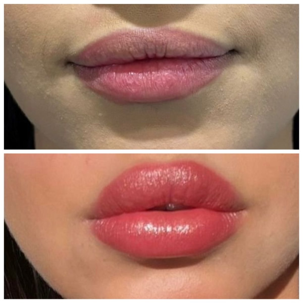 Resultados antes y después de relleno de labios: mayor volumen y mejora del contorno