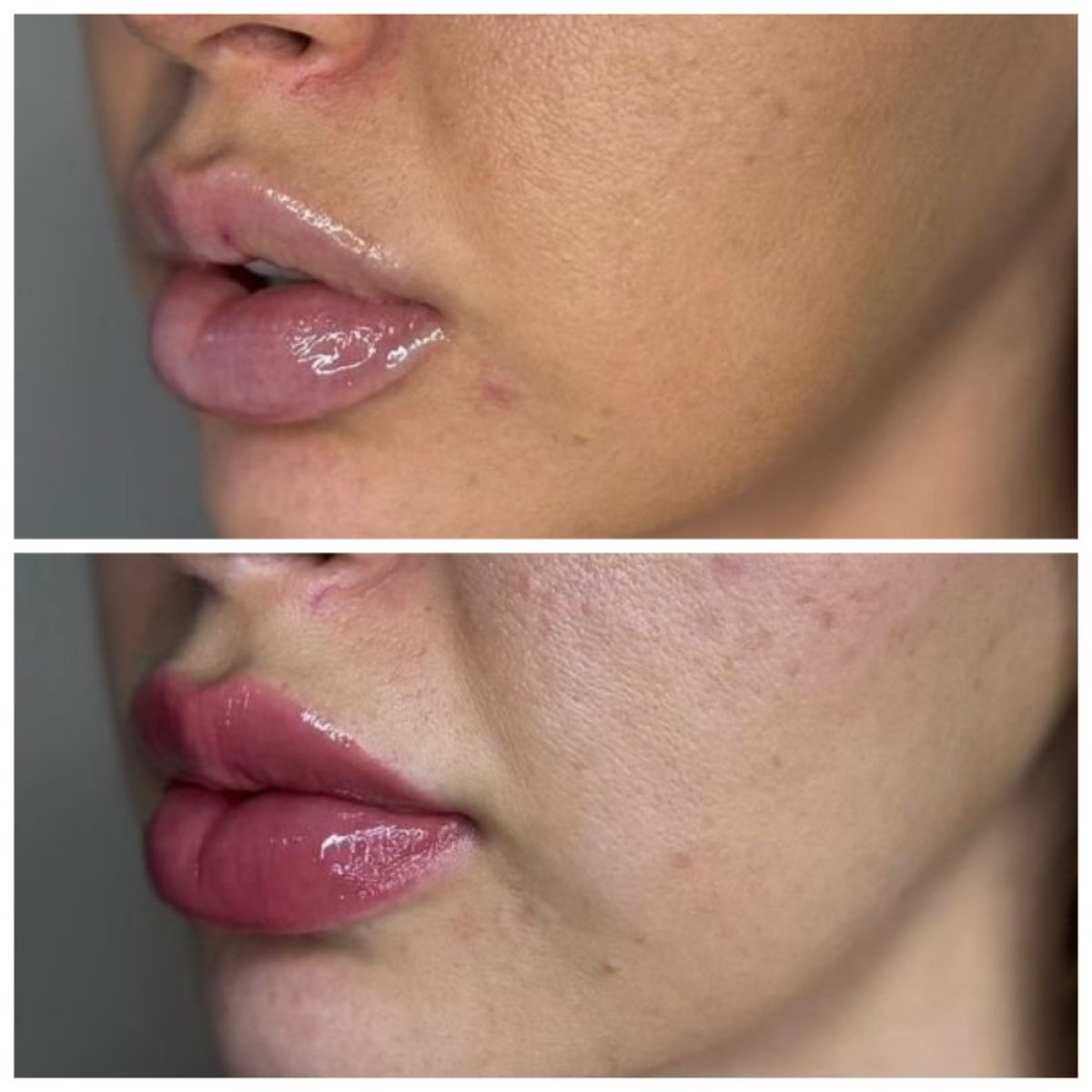 Résultat avant-après injection de fillers – volume et contour des lèvres améliorés