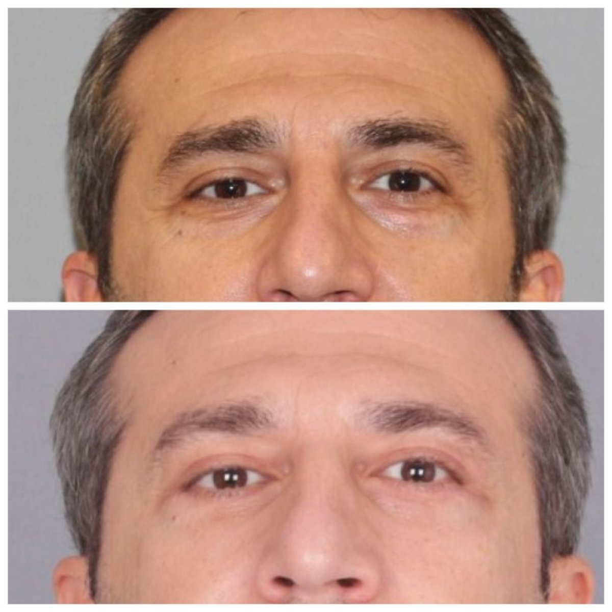 Resultados de blefaroplastia de párpado inferior antes y después en Quartz Hospital, menos bolsas