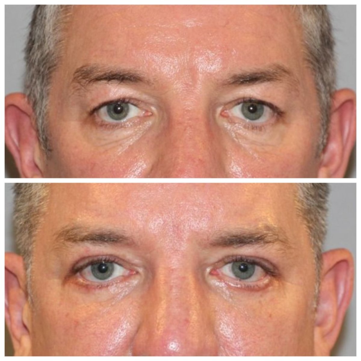 Resultados de blefaroplastia inferior antes y después en Quartz Hospital, menos bolsas oculares