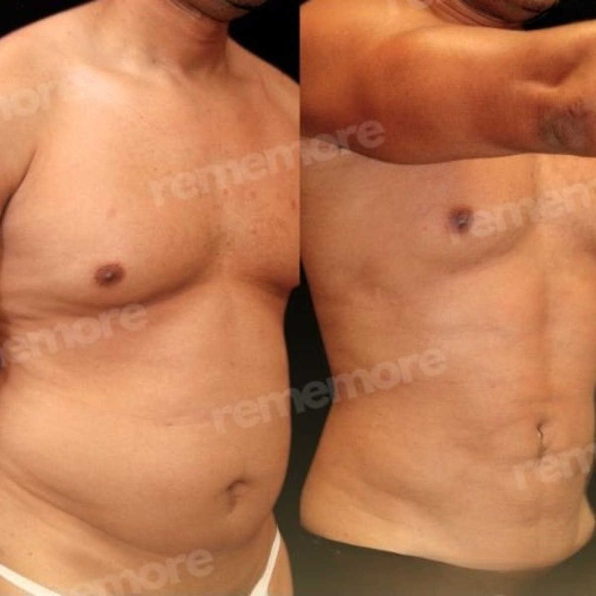 Résultats avant/après sculpture abdominale à Memorial Şişli Hospital, abdos dessinés