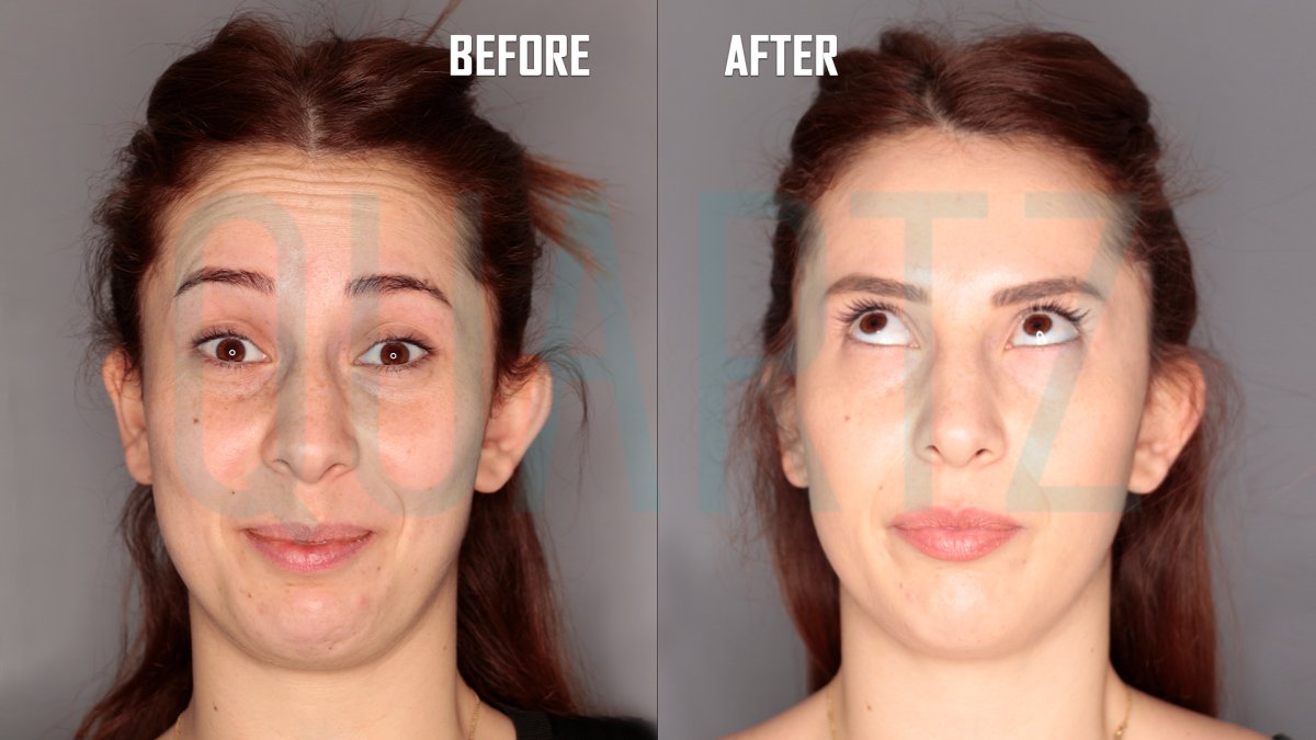 Antes y después de inyecciones de bótox en Quartz Hospital, resultado visible en la frente