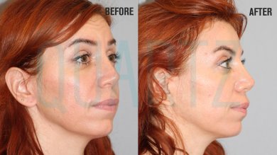 Premium Botox Injections — 3 Areas for Smooth & Refreshed Appearance - photo 4