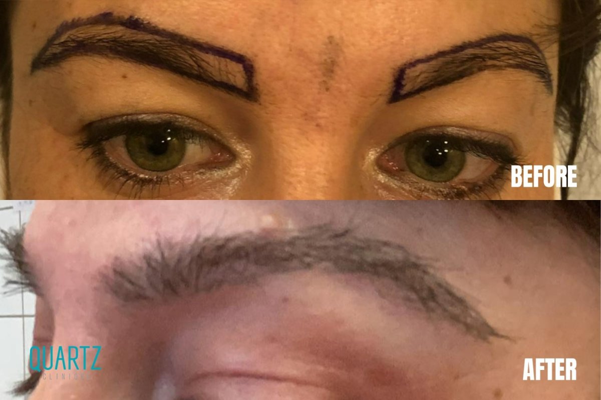 Before and after eyebrow transplantation results at Quartz Hospital, fuller natural brows