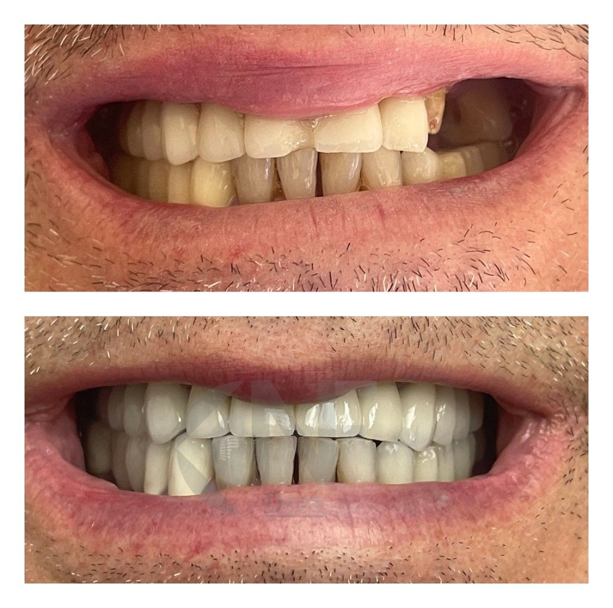 Resultados de implante dental de carga inmediata antes y después en Nifa Dent International, sonrisa restaurada