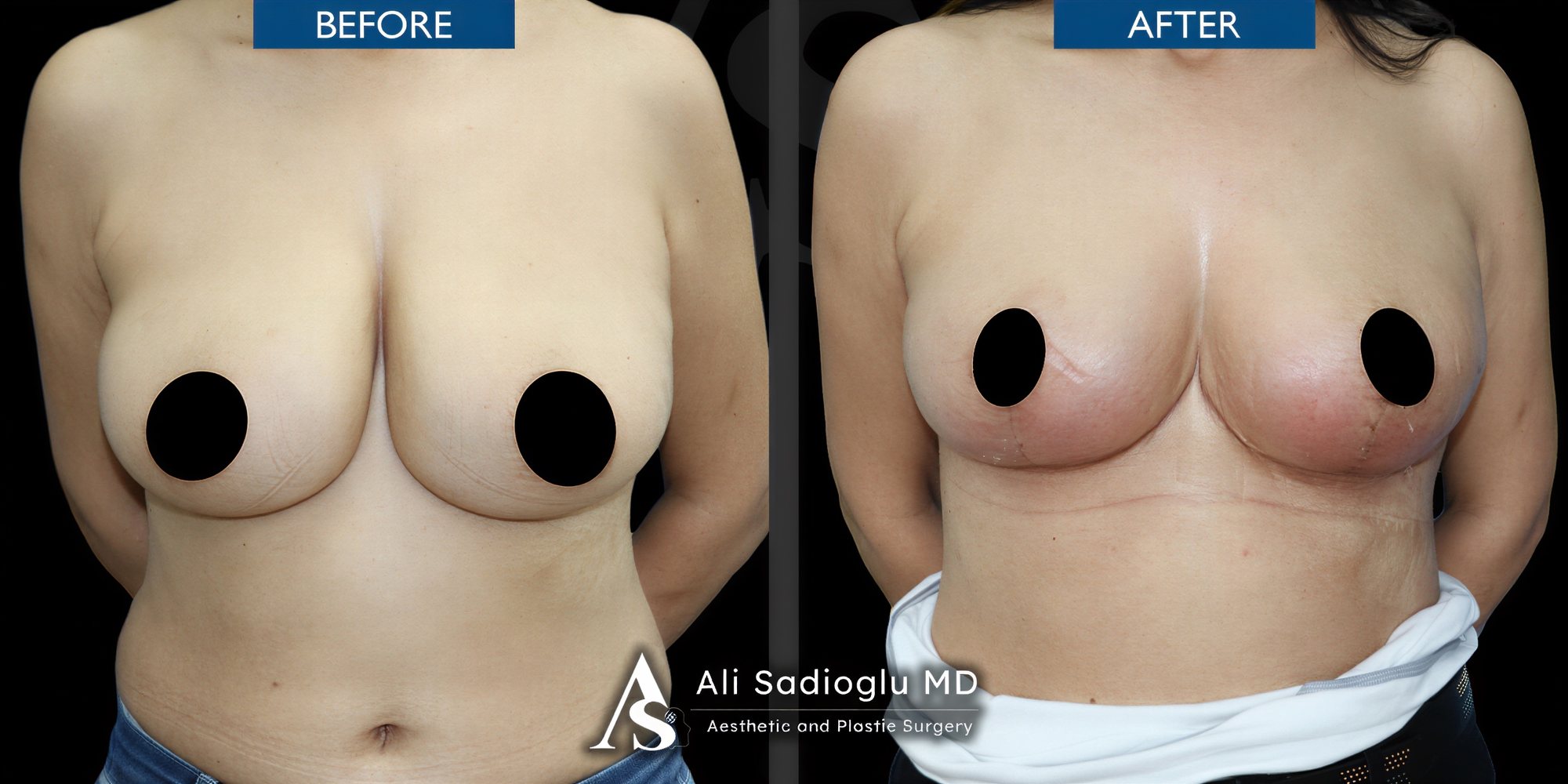 Resultados de lifting de senos antes y después en Dr. Safa Manav Clinic, contorno mejorado