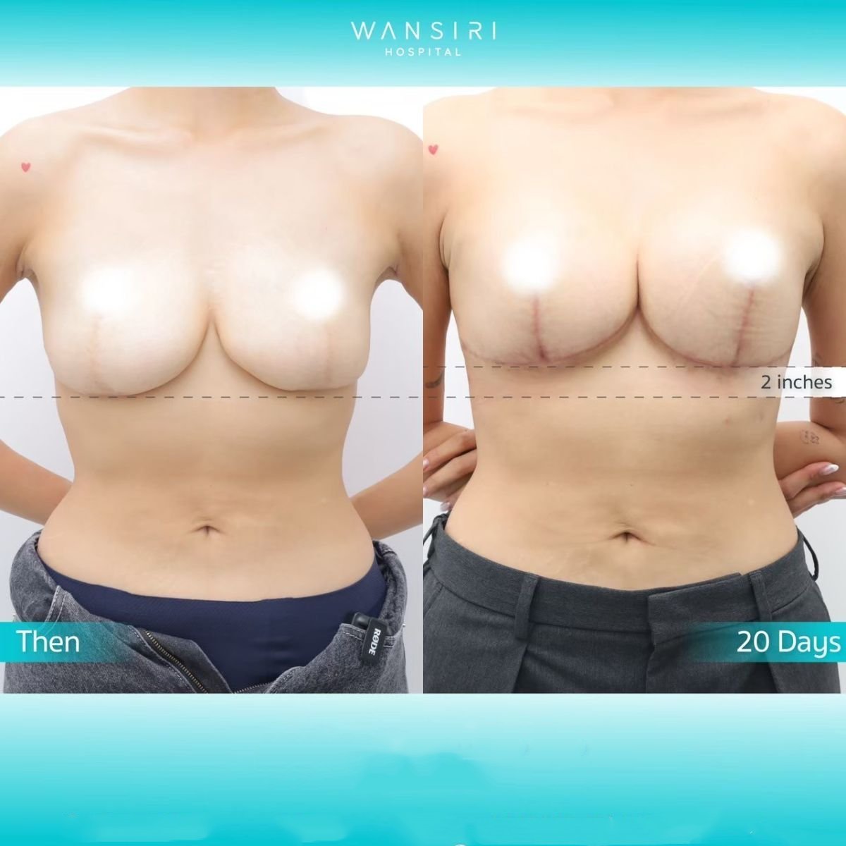 Résultats avant/après lifting mammaire à Wansiri Hospital, meilleure forme des seins