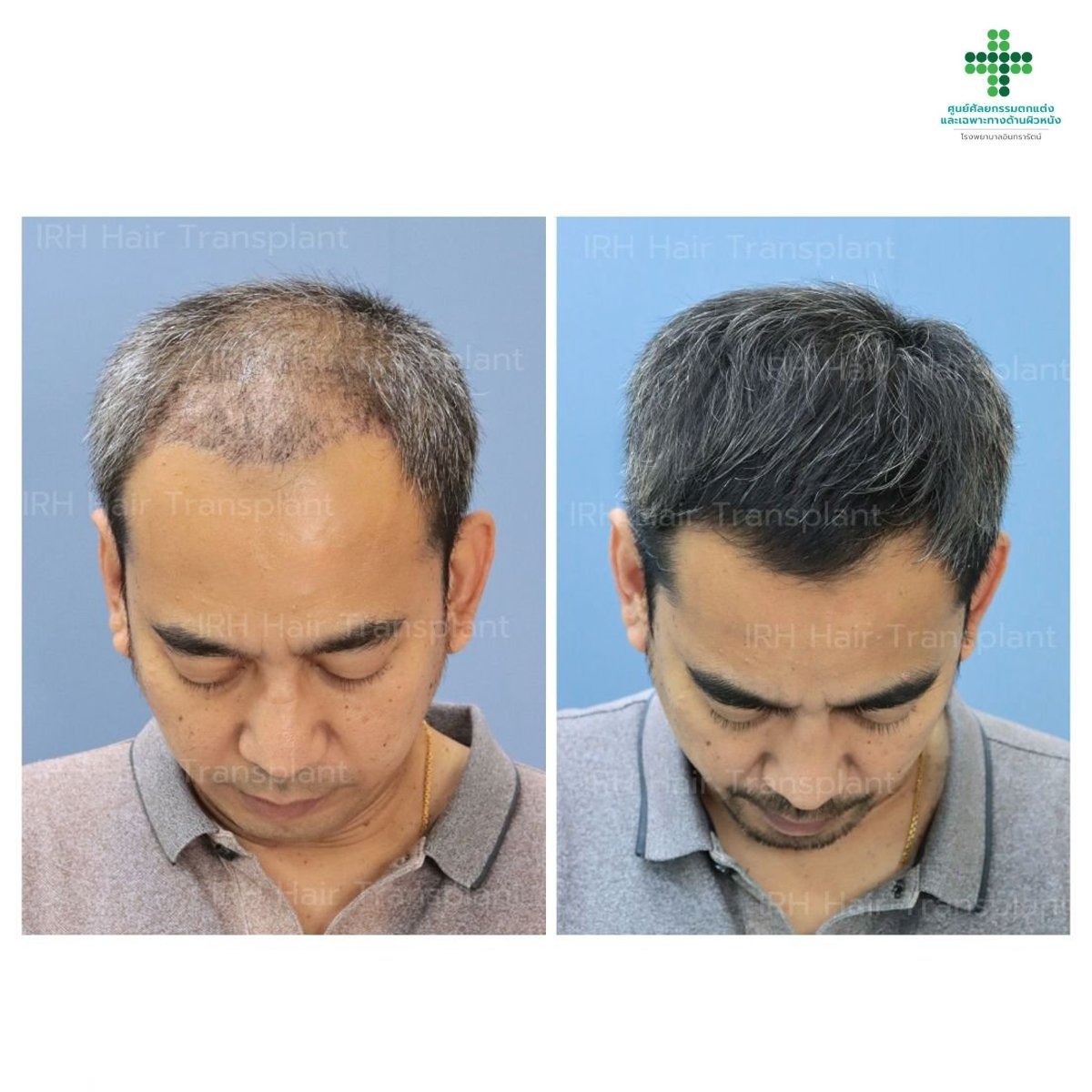 نتائج زراعة الشعر FUE قبل وبعد في مستشفى إنترارات – كثافة شعر محسنة