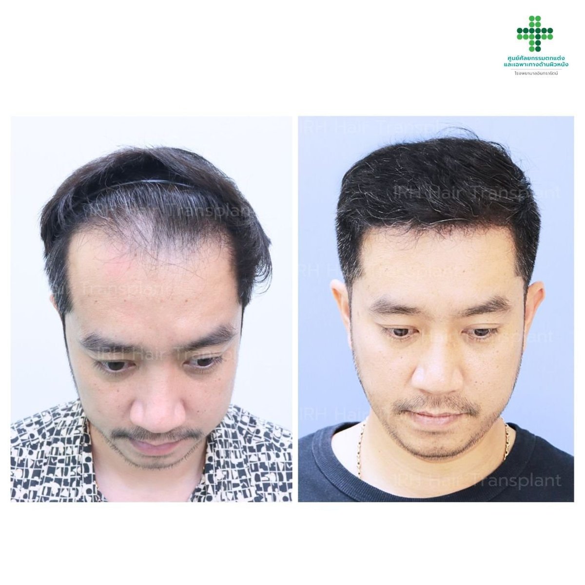 نتائج زراعة الشعر FUE قبل وبعد في مستشفى إنترارات مع خط شعر أكثر كثافة