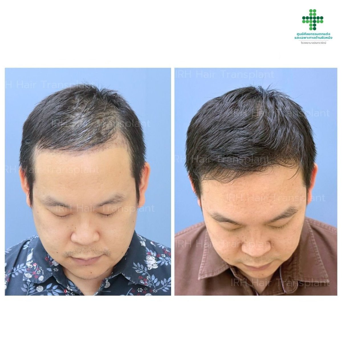 نتائج زراعة الشعر FUE قبل وبعد في مستشفى إنترارات، كثافة شعر محسنة
