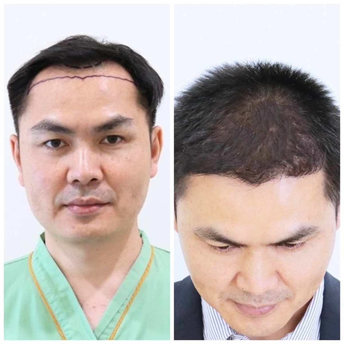 نتائج زراعة الشعر FUE قبل وبعد في مستشفى إنترارات، كثافة خط الشعر المحسنة