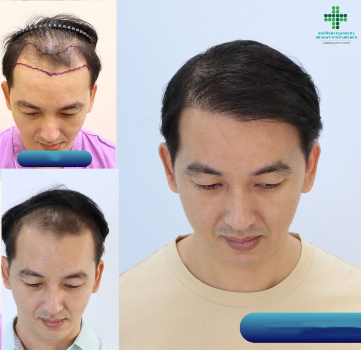 Résultats avant et après greffe de cheveux FUE à Intrarat Hospital, ligne capillaire plus dense
