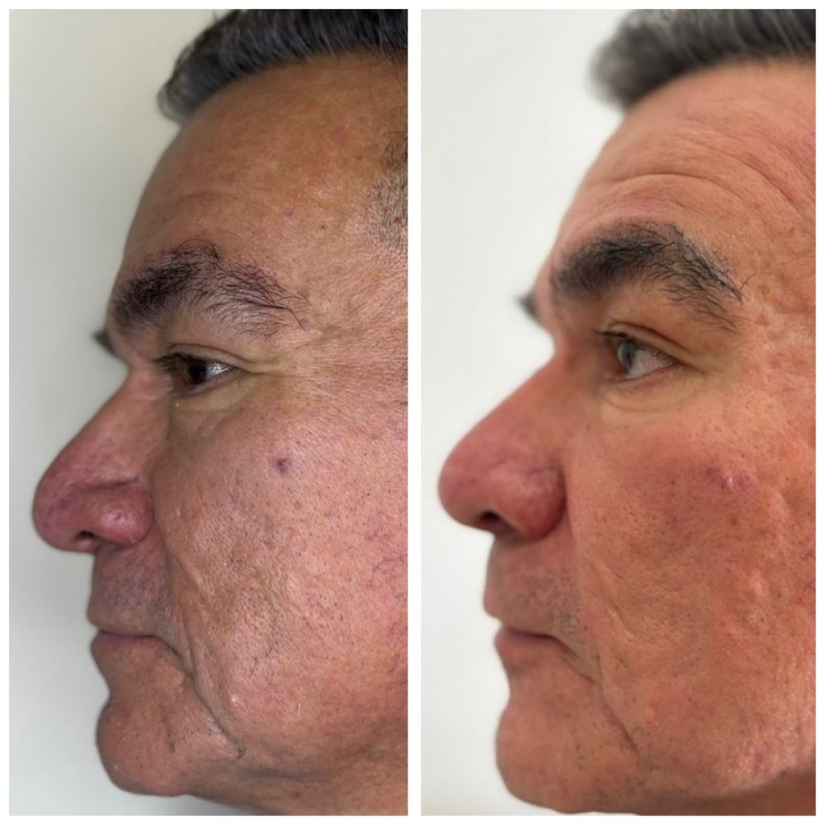 Résultats avant/après lifting par fils chez un homme – peau du visage raffermie