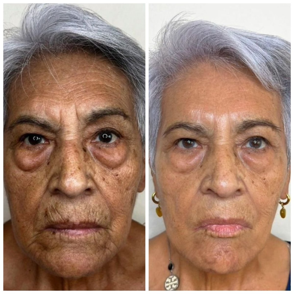 Resultados antes y después de terapia rejuvenecedora con células madre – menos arrugas y piel suave