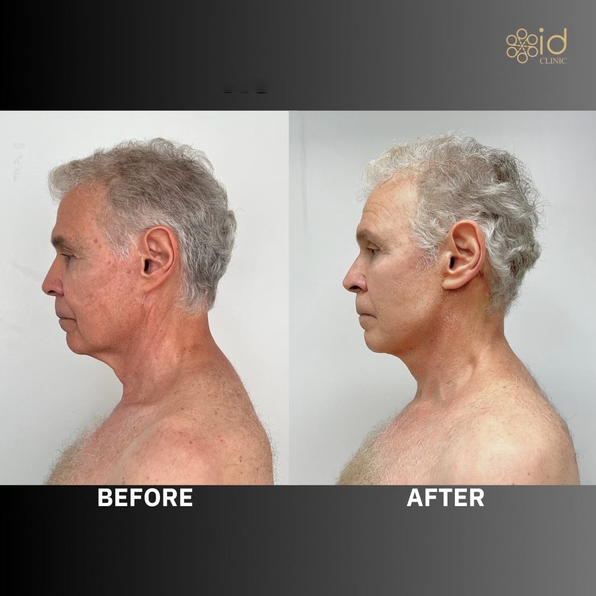 Resultados de lifting facial antes y después en ID Clinic Bangkok, rejuvenecimiento masculino
