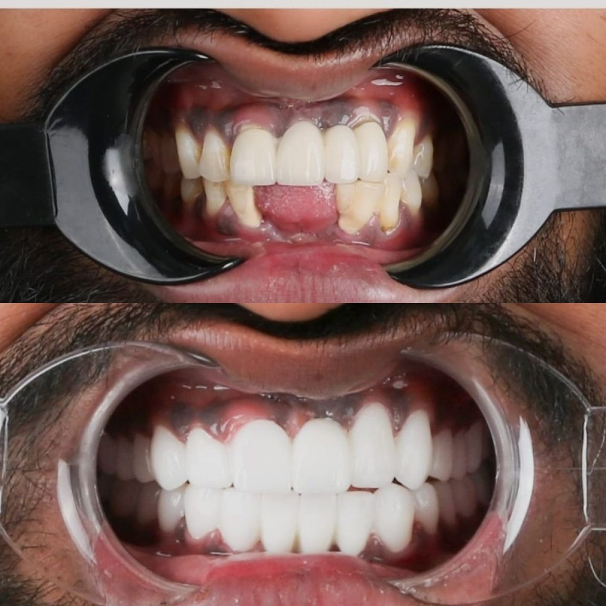 Before and after dental crown installation results at CE International Hospital, improved smile