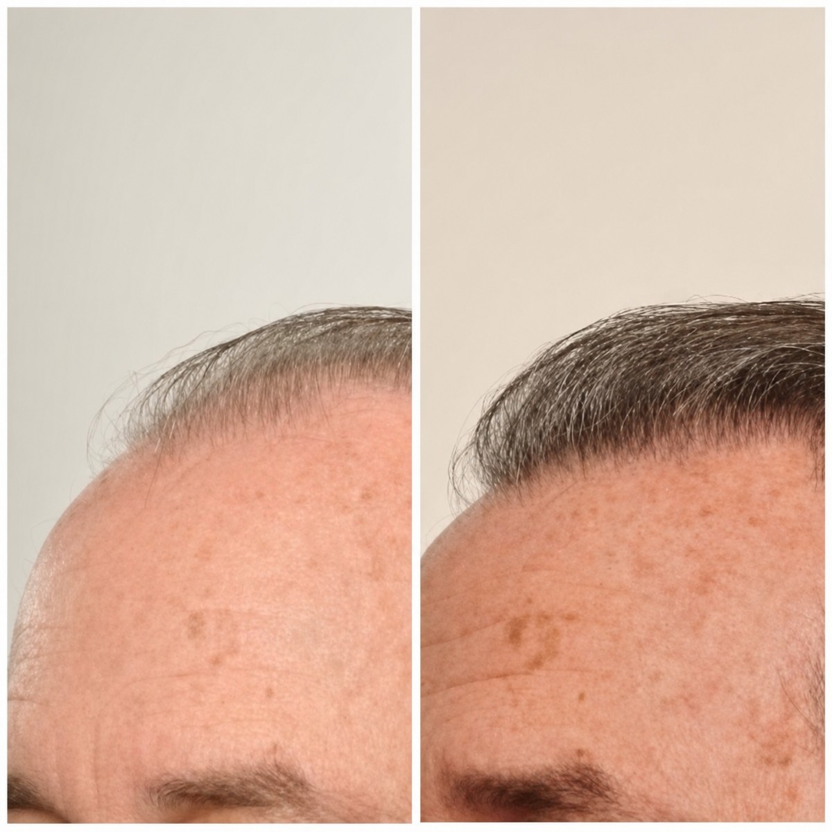 Avant et après thérapie par cellules souches pour restauration capillaire chez Dr. Abraham Miranda