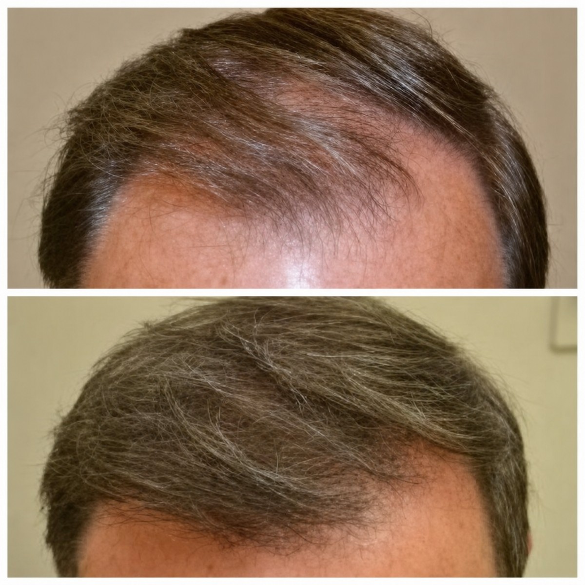 Avant et après thérapie par cellules souches pour restauration capillaire chez Dr. Abraham Miranda