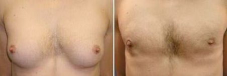 Fotos de antes y después de Cirugía de ginecomastia tomadas por el Dr.(la Dra.) Tanongsak Panyawirunroj