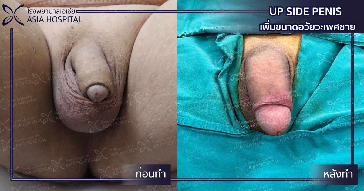 نتائج قبل وبعد تكبير القضيب في Asia Cosmetic Hospital، زيادة واضحة في الحجم