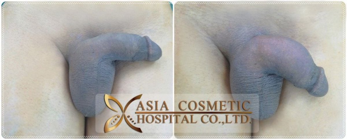 Before and after penis enlargement results at Asia Cosmetic Hospital, visible size increase