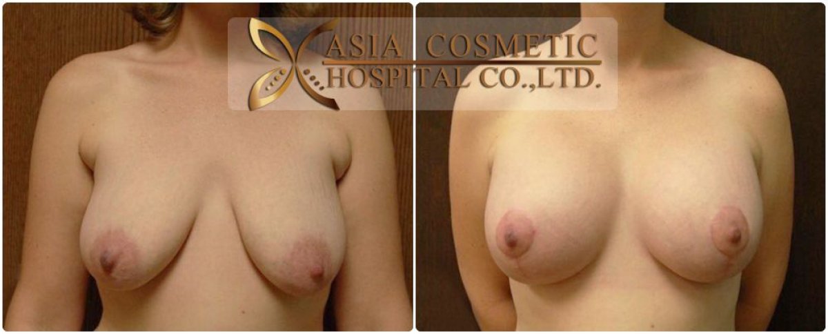 Before and after nipple correction results at Asia Cosmetic Hospital, improved breast appearance