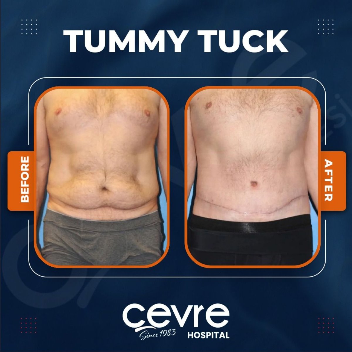 Before and after tummy tuck results at Adem and Havva Medical Center, visible flatter abdomen