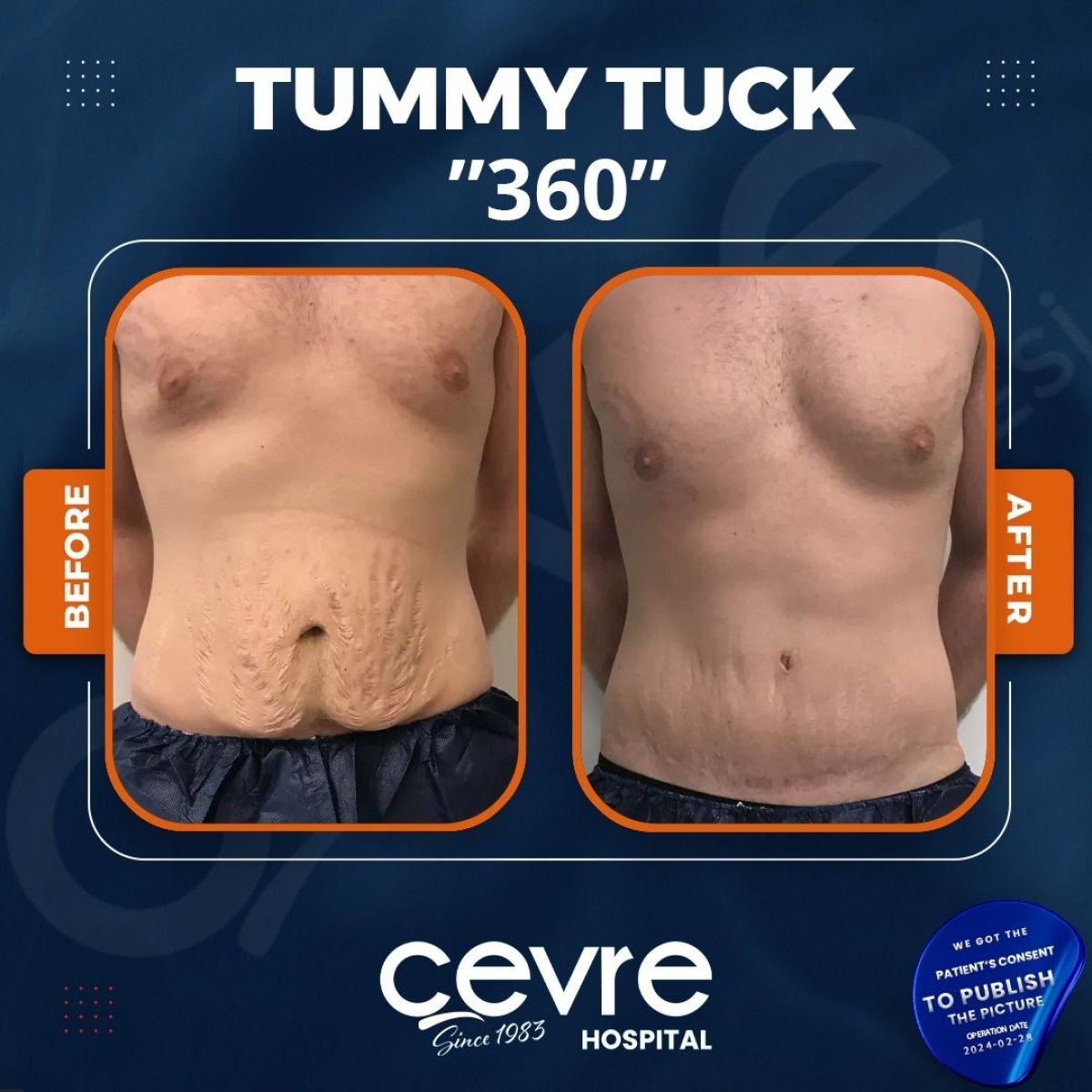 Before and after tummy tuck 360 results at Cevre Hospital, visible abdominal contour improvement