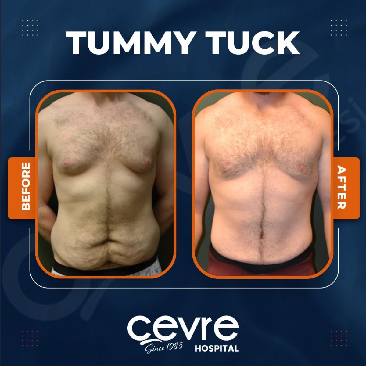 Before and after tummy tuck results at Adem and Havva Medical Center, improved abdomen contour